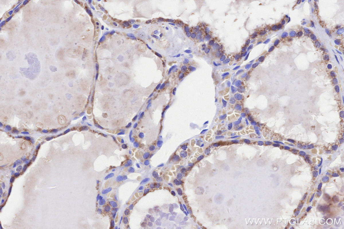 Immunohistochemical analysis of paraffin-embedded human thyroid cancer tissue slide using KHC3286 (HSCB IHC Kit).