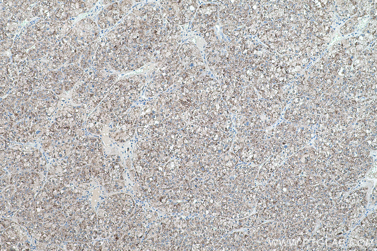Immunohistochemical analysis of paraffin-embedded human liver cancer tissue slide using KHC0573 (HSD17B4 IHC Kit).