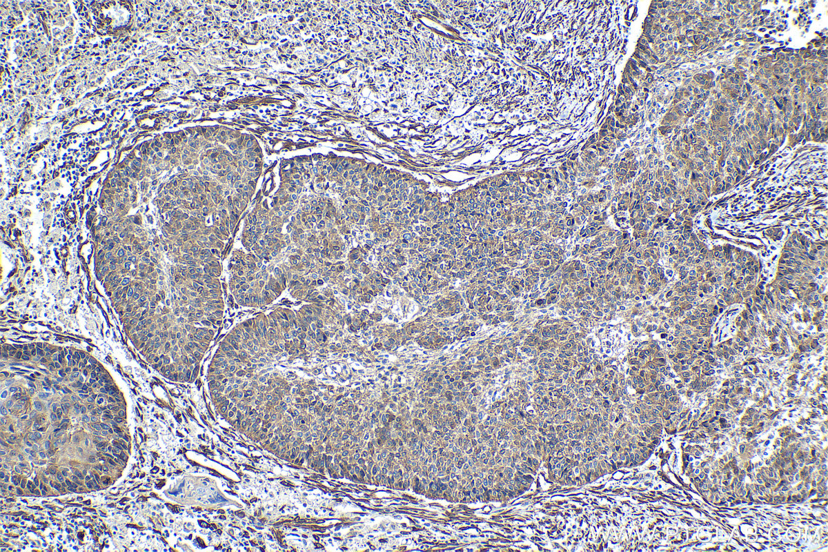 Immunohistochemical analysis of paraffin-embedded human lung cancer tissue slide using KHC1241 (HSP47 IHC Kit).