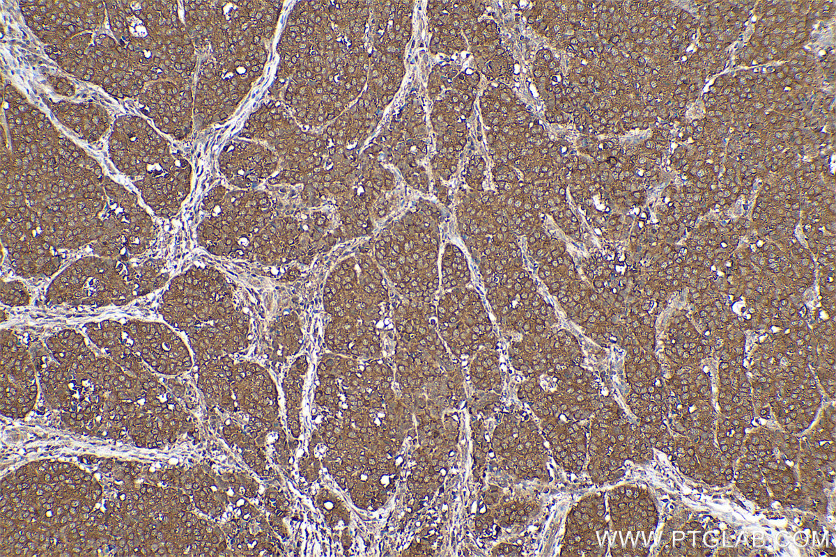 Immunohistochemical analysis of paraffin-embedded human stomach cancer tissue slide using KHC0659 (HSP90AA1 IHC Kit).