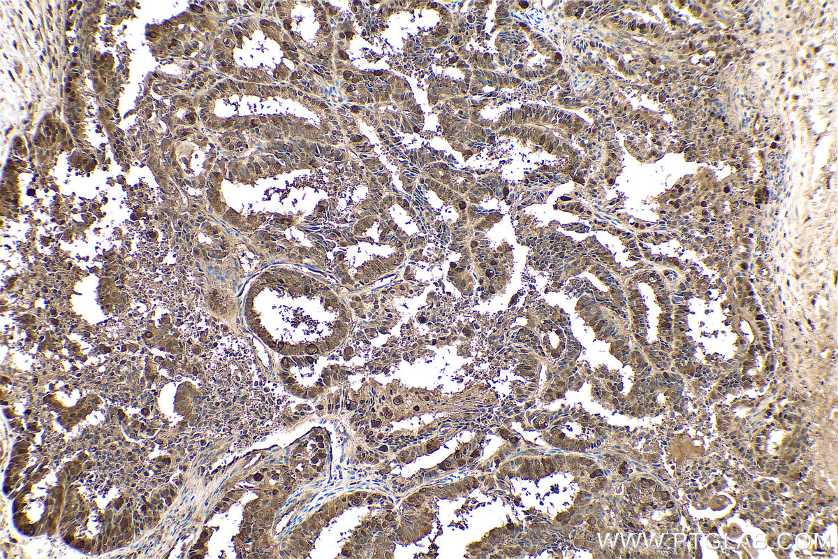 Immunohistochemical analysis of paraffin-embedded human ovary tumor tissue slide using KHC0659 (HSP90AA1 IHC Kit).