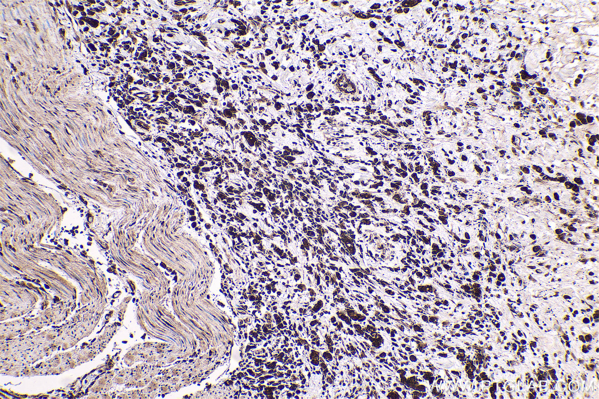 Immunohistochemical analysis of paraffin-embedded human stomach cancer tissue slide using KHC0564 (HSP90AB1 IHC Kit).