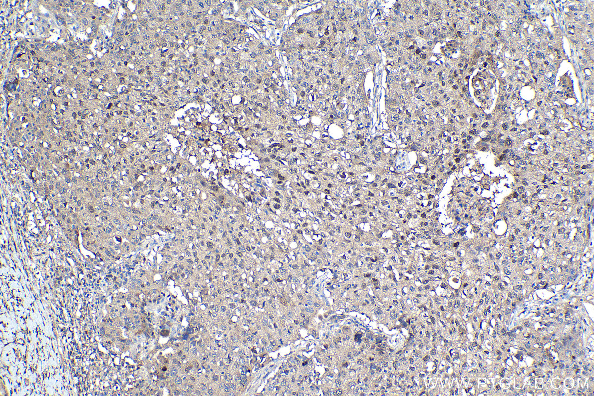 Immunohistochemical analysis of paraffin-embedded human lung cancer tissue slide using KHC1134 (HSPA6 IHC Kit).