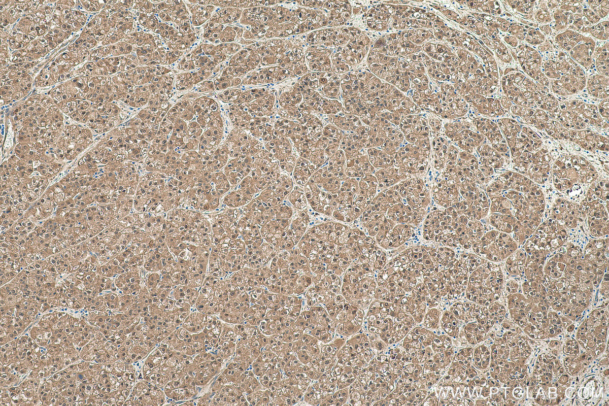 Immunohistochemical analysis of paraffin-embedded human liver cancer tissue slide using KHC0427 (HSPB1 IHC Kit).