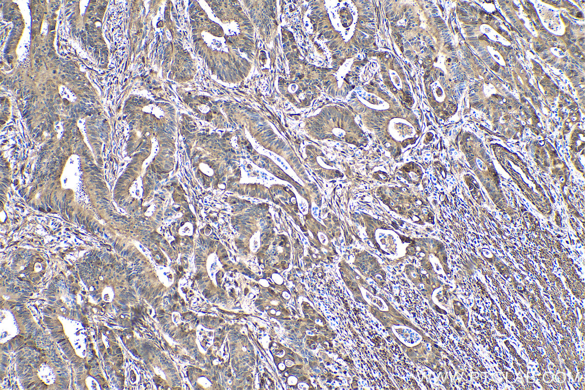 Immunohistochemical analysis of paraffin-embedded human colon cancer tissue slide using KHC0427 (HSPB1 IHC Kit).