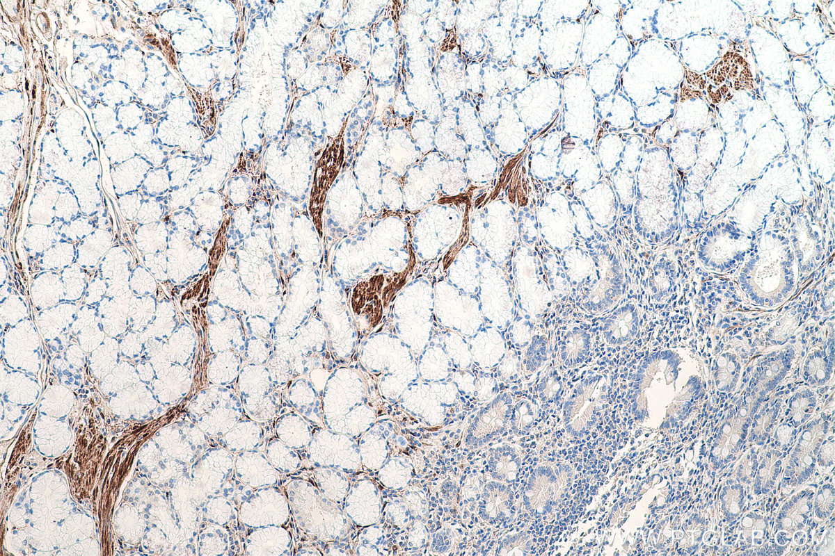 Immunohistochemical analysis of paraffin-embedded human stomach cancer tissue slide using KHC0668 (HSPB6 IHC Kit).