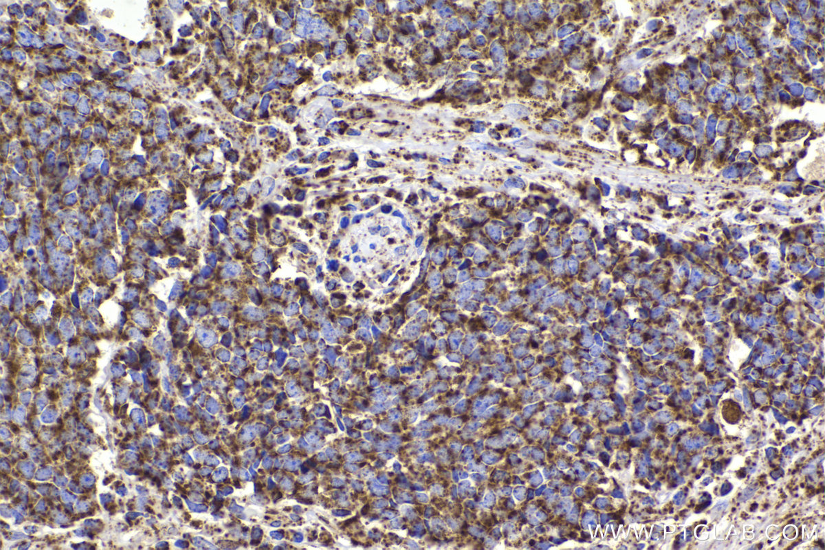 Immunohistochemical analysis of paraffin-embedded human lung cancer tissue slide using KHC2340 (HSP10 IHC Kit).