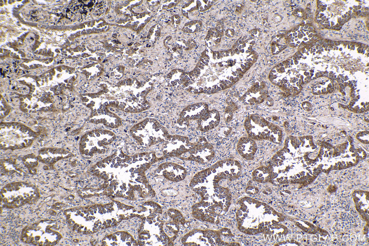 Immunohistochemical analysis of paraffin-embedded human lung cancer tissue slide using KHC1597 (HTT IHC Kit).