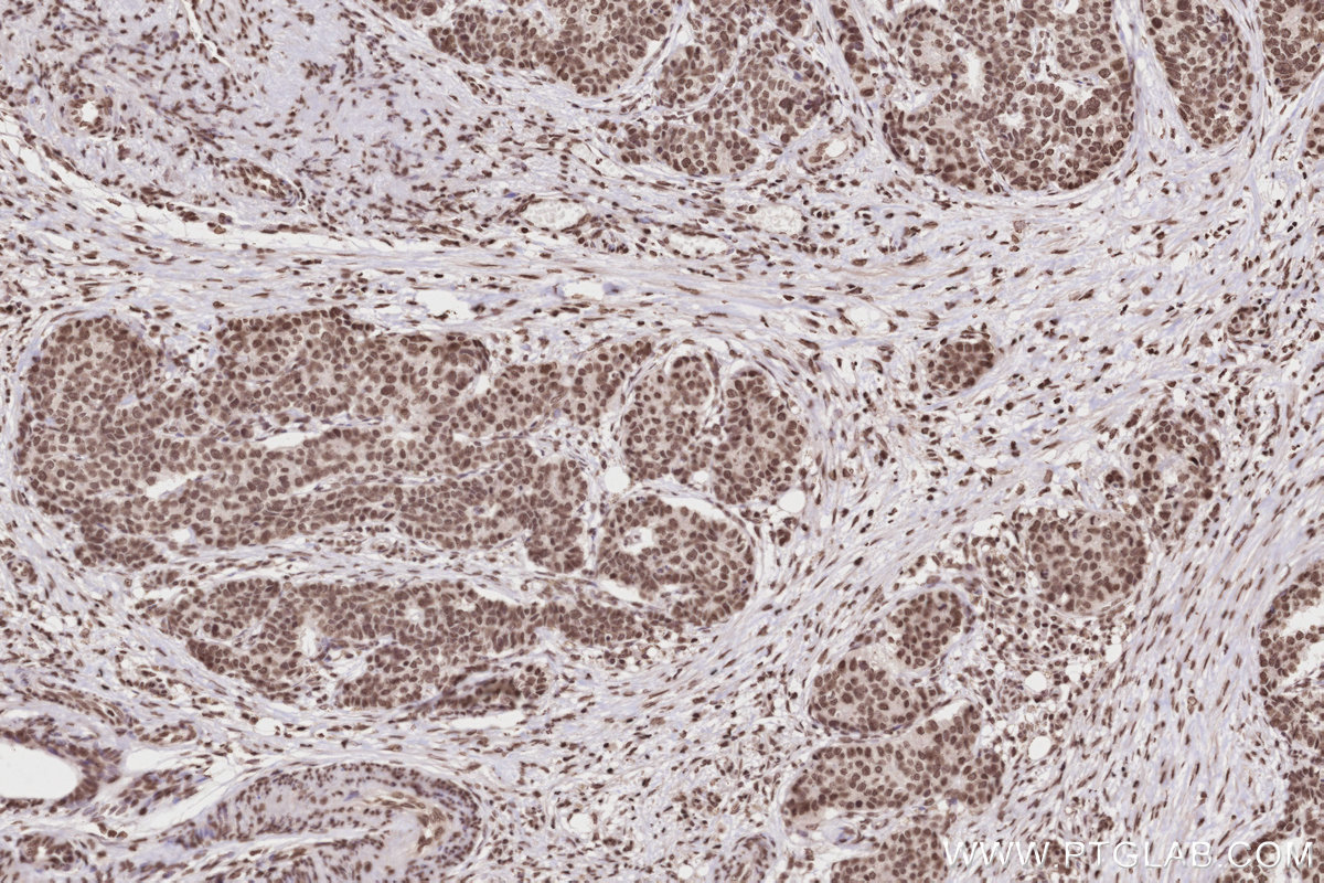 Immunohistochemical analysis of paraffin-embedded human stomach cancer tissue slide using KHC2823 (Histone H2A  IHC Kit).