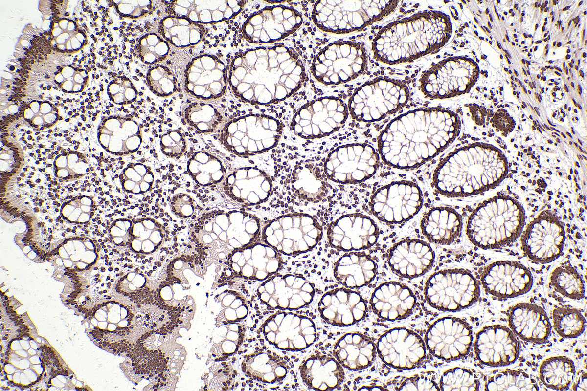 Immunohistochemical analysis of paraffin-embedded human rectal cancer tissue slide using KHC2506 (Histone H3.4 IHC Kit).