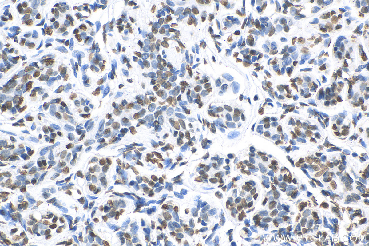 Immunohistochemical analysis of paraffin-embedded human breast cancer tissue slide using KHC0568 (Histone-H3 IHC Kit).