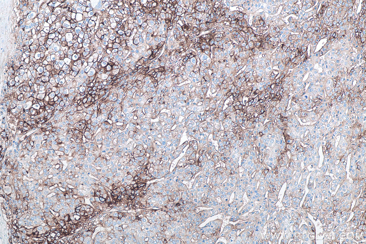 Immunohistochemical analysis of paraffin-embedded human liver cancer tissue slide using KHC0080 (ICAM-1 IHC Kit).