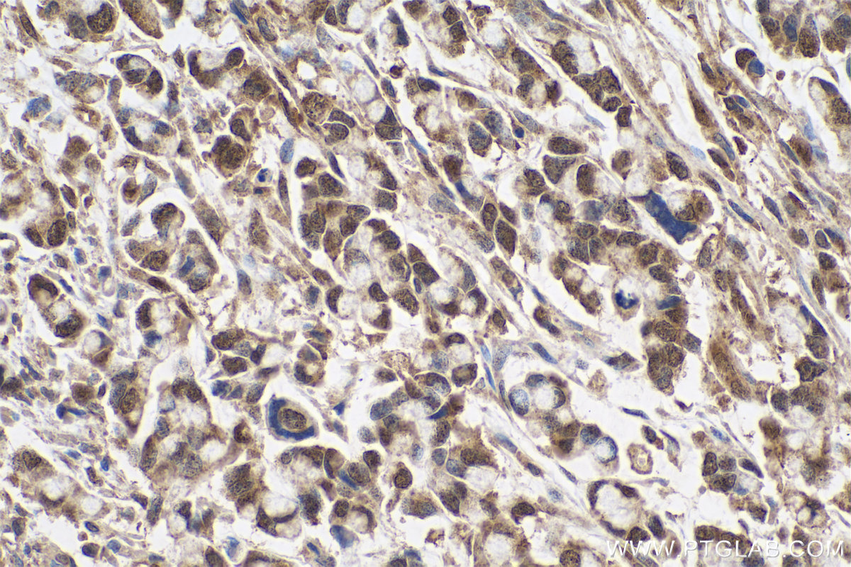 Immunohistochemical analysis of paraffin-embedded human colon cancer tissue slide using KHC0627 (ID1 IHC Kit).