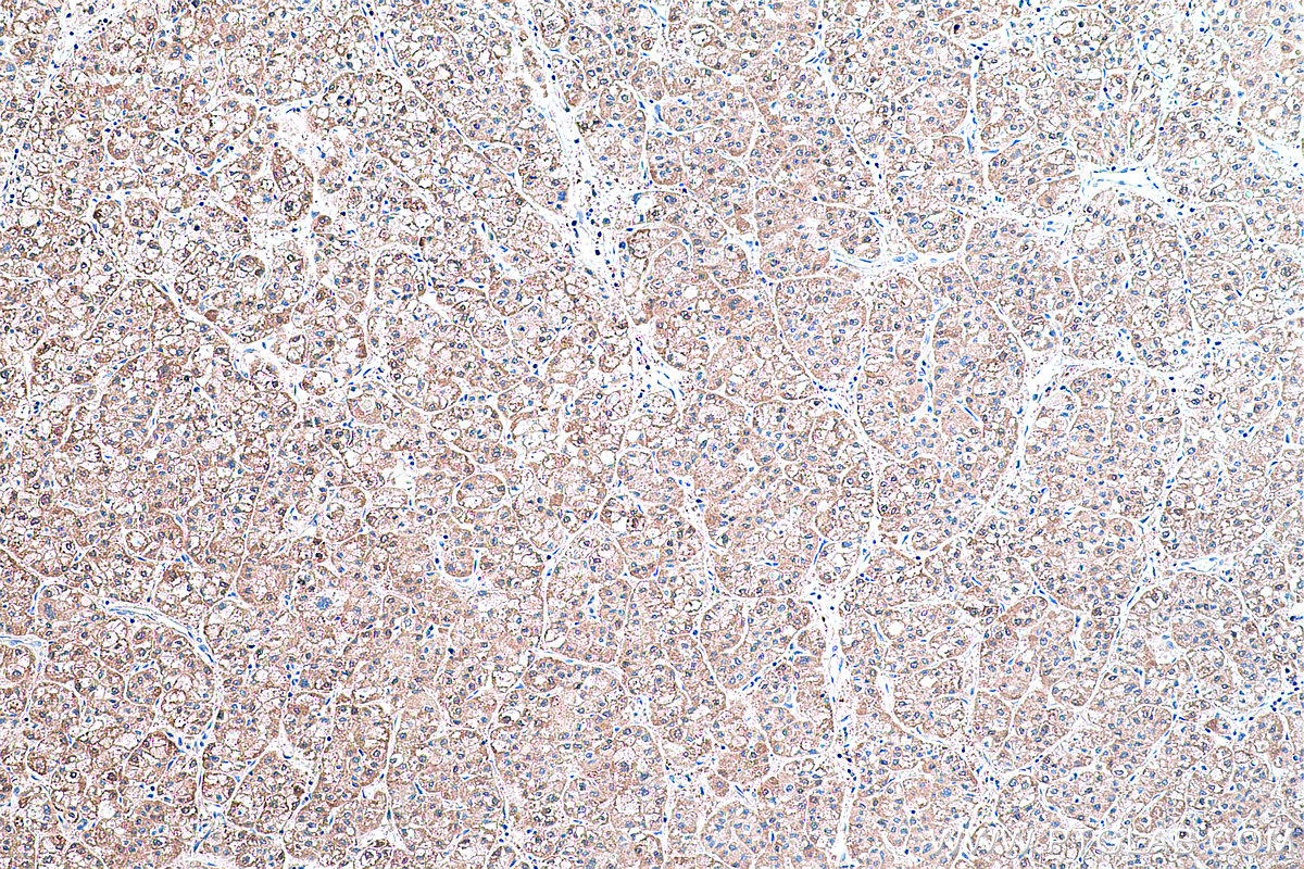 Immunohistochemical analysis of paraffin-embedded human liver cancer tissue slide using KHC0428 (IDI1 IHC Kit).