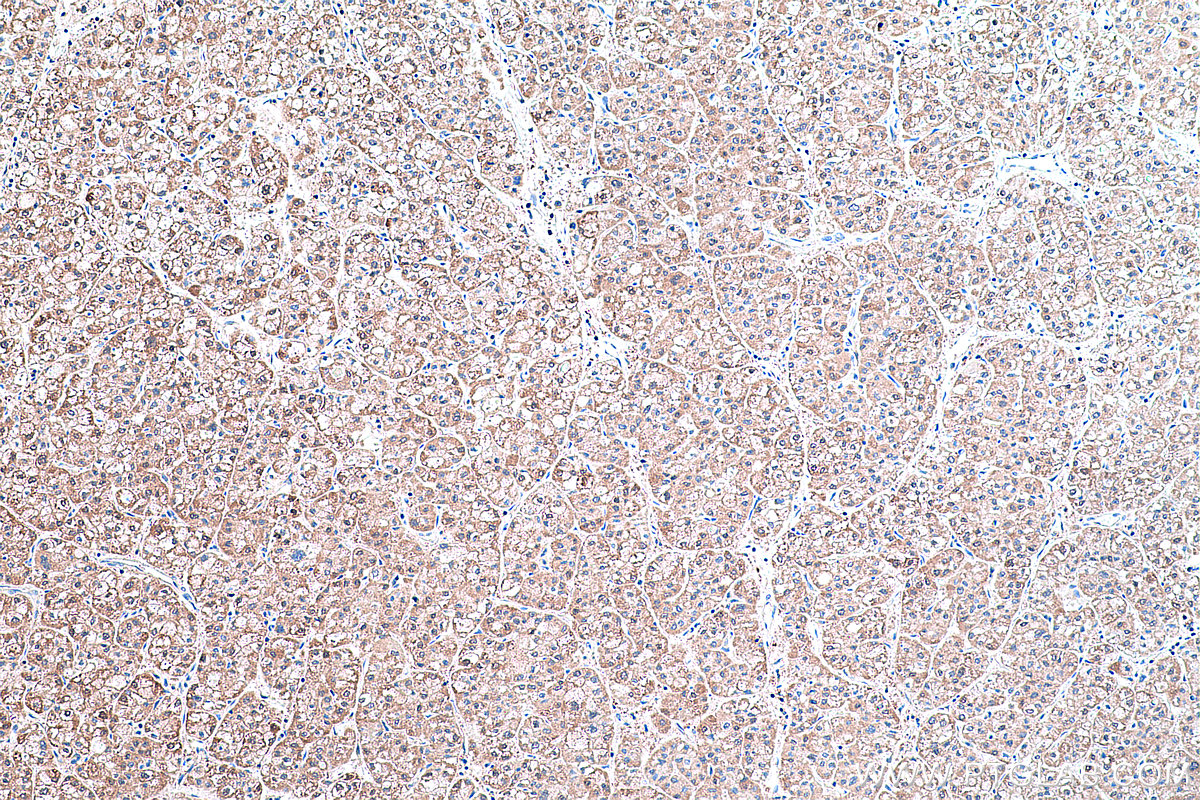 Immunohistochemical analysis of paraffin-embedded human liver cancer tissue slide using KHC0428 (IDI1 IHC Kit).