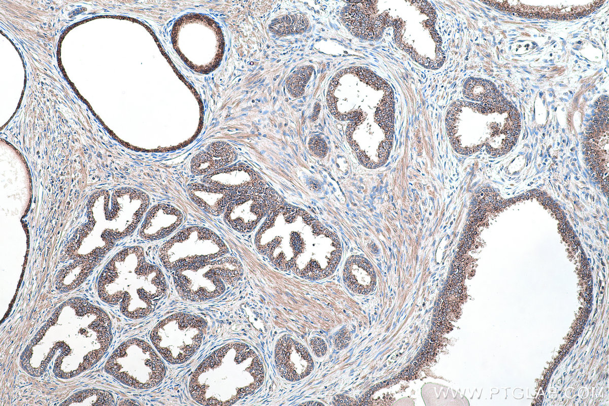 Immunohistochemical analysis of paraffin-embedded human prostate cancer tissue slide using KHC0428 (IDI1 IHC Kit).