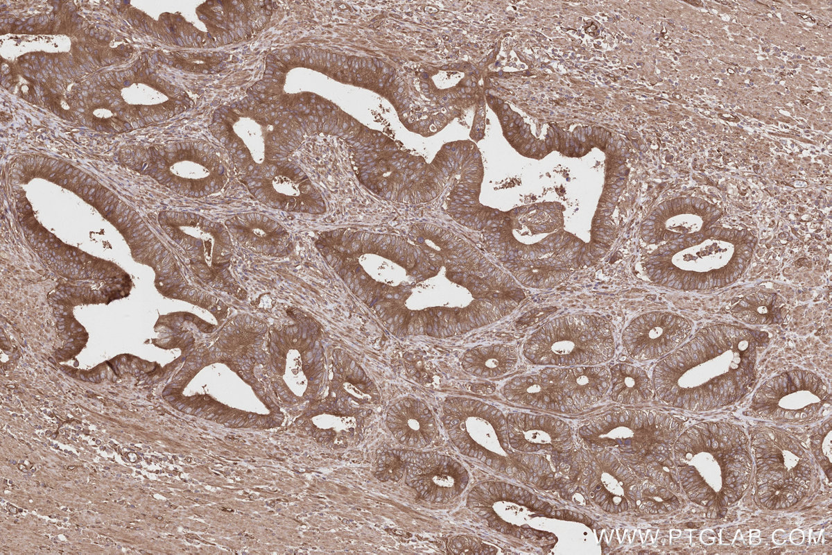 Immunohistochemical analysis of paraffin-embedded human rectal cancer tissue slide using KHC2806 (IFT74 IHC Kit). Immunohistochemical analysis of paraffin-embedded human rectal cancer tissue slide using KHC2806 (IFT74 IHC Kit).