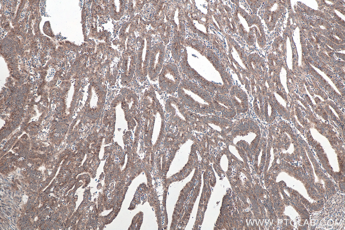 Immunohistochemical analysis of paraffin-embedded human endometrial cancer tissue slide using KHC0160 (IGF2BP1 IHC Kit).