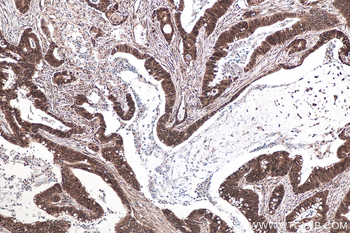 Immunohistochemical analysis of paraffin-embedded human colon cancer tissue slide using KHC0160 (IGF2BP1 IHC Kit).