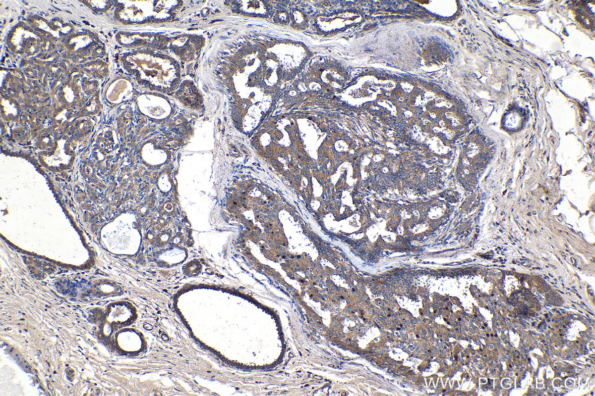 Immunohistochemical analysis of paraffin-embedded human breast cancer tissue slide using KHC1361 (IGF2R-Specific IHC Kit).