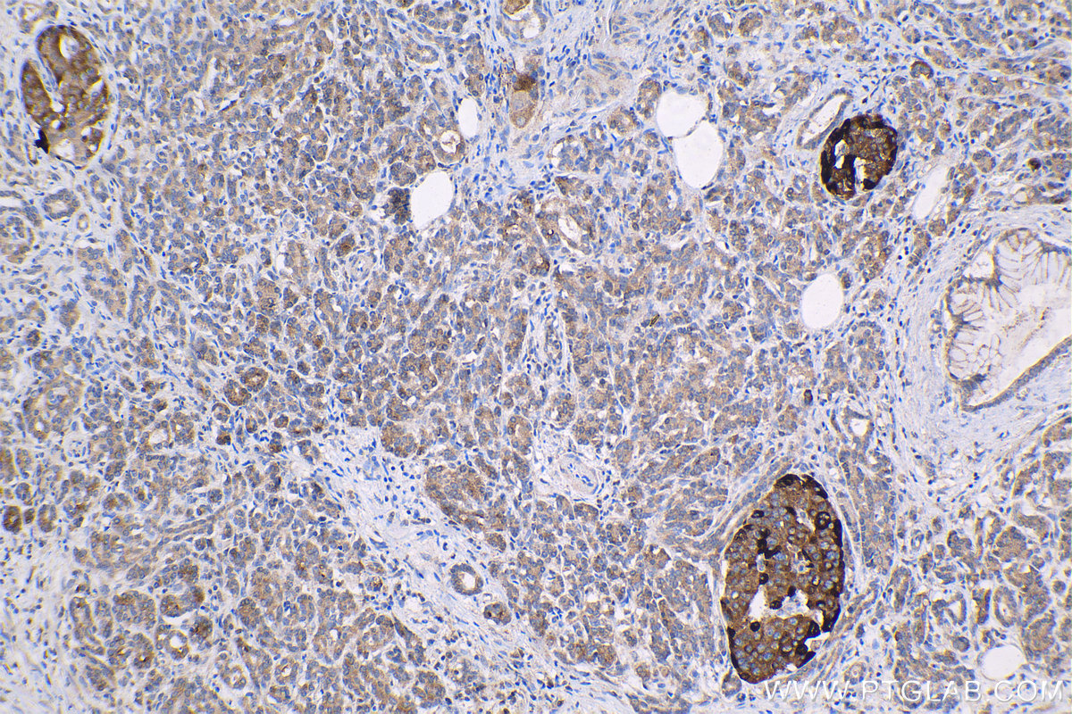 Immunohistochemical analysis of paraffin-embedded human pancreas cancer tissue slide using KHC1333 (IGFBP2 IHC Kit).