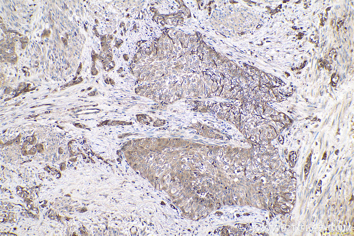 Immunohistochemical analysis of paraffin-embedded human urothelial carcinoma tissue slide using KHC0629 (IGFBP3 IHC Kit).