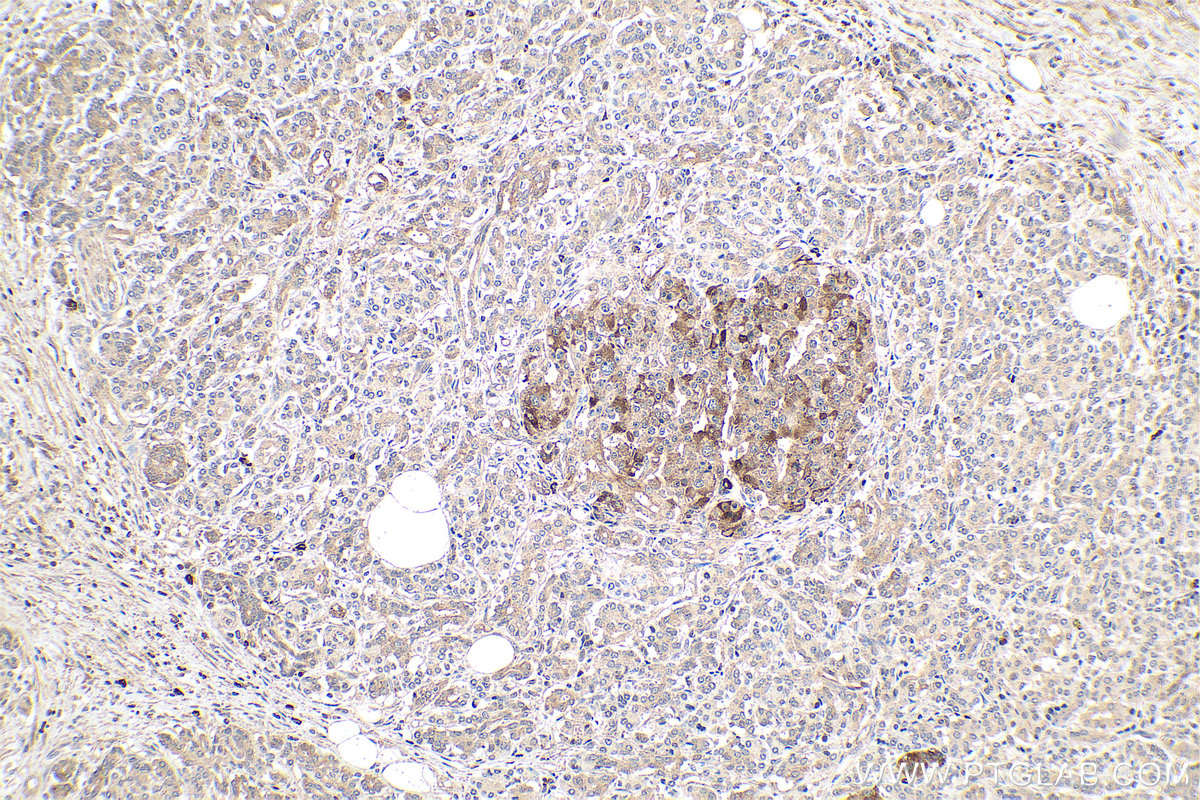 Immunohistochemical analysis of paraffin-embedded human pancreas cancer tissue slide using KHC0629 (IGFBP3 IHC Kit).