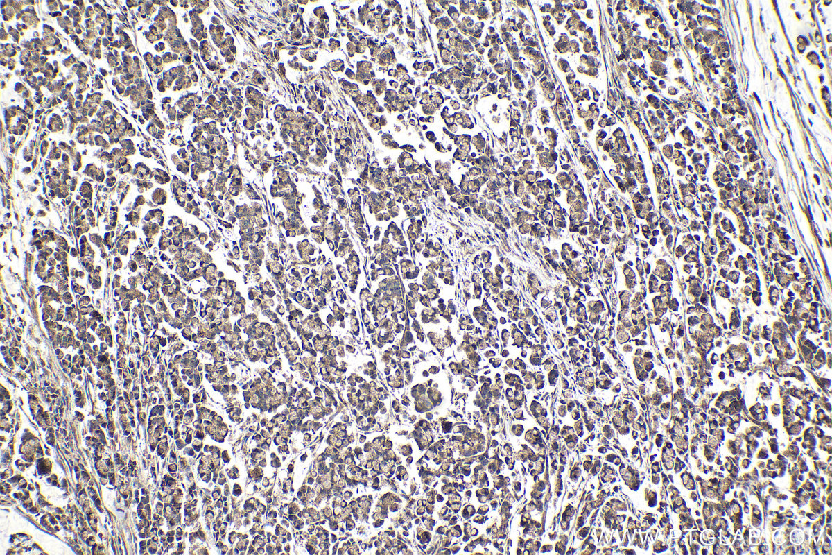 Immunohistochemical analysis of paraffin-embedded human colon cancer tissue slide using KHC1051 (IGFBP7 IHC Kit).