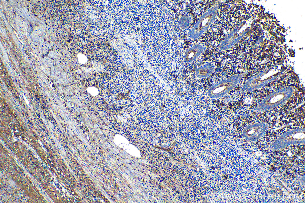 Immunohistochemical analysis of paraffin-embedded human appendicitis tissue slide using KHC1194 (IGJ IHC Kit).