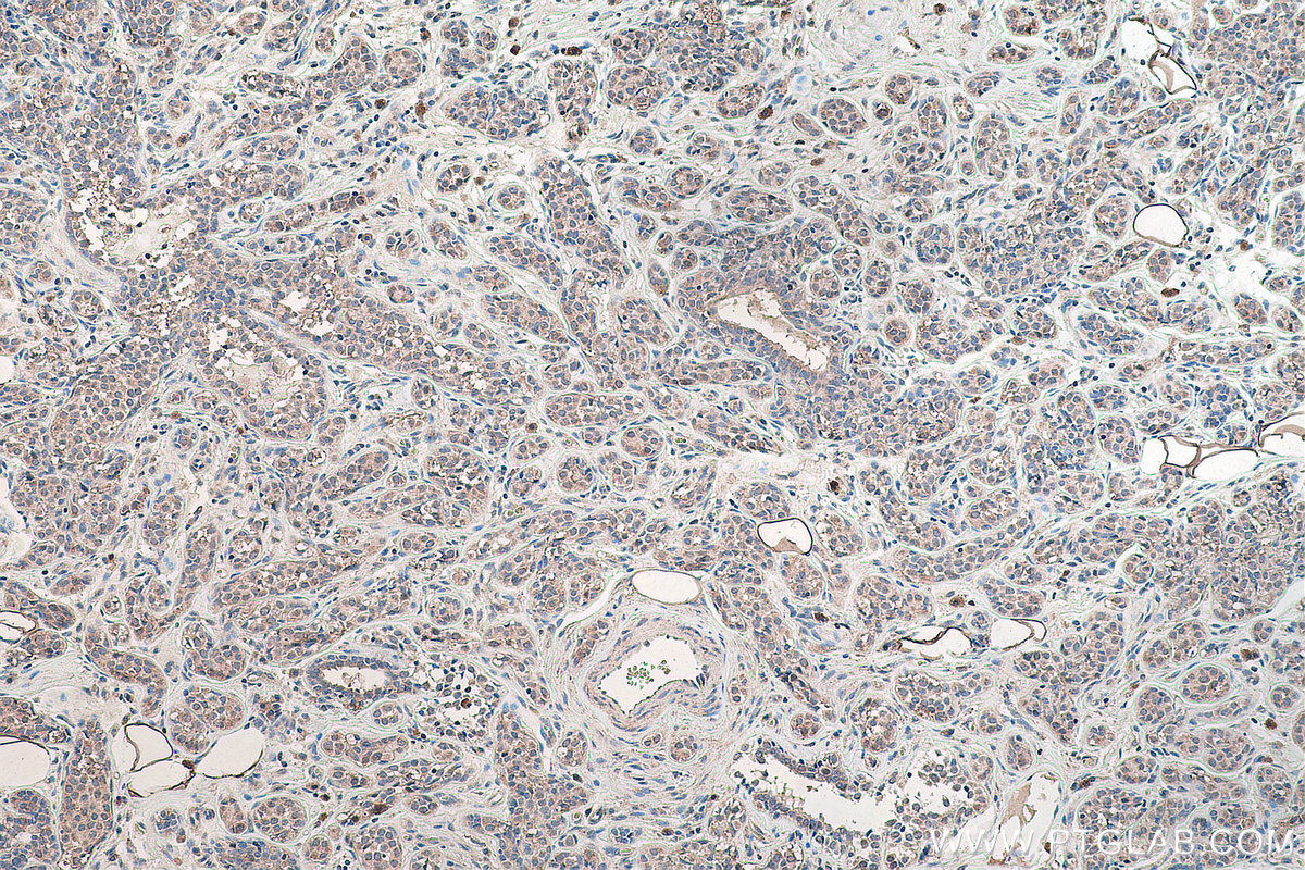 Immunohistochemical analysis of paraffin-embedded human breast cancer tissue slide using KHC0135 (IHH IHC Kit).