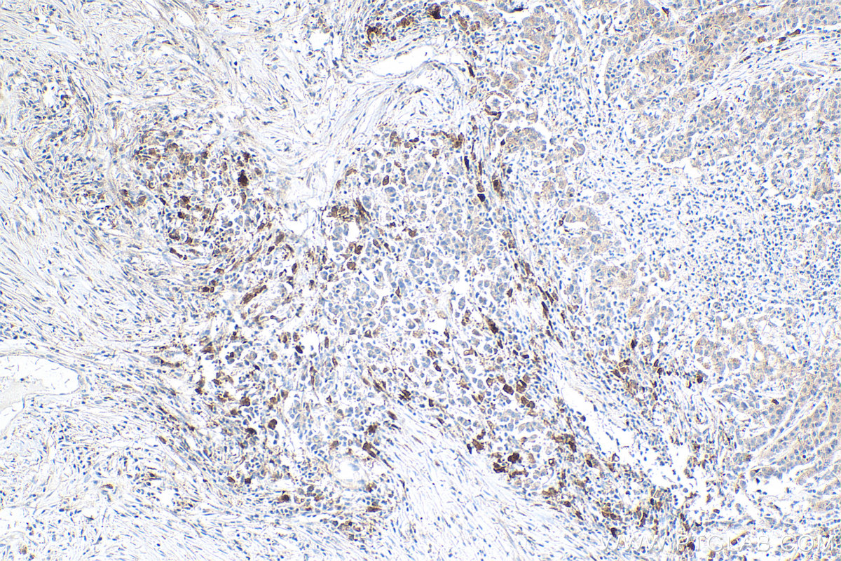 Immunohistochemical analysis of paraffin-embedded human stomach cancer tissue slide using KHC0308 (IL18 IHC Kit).