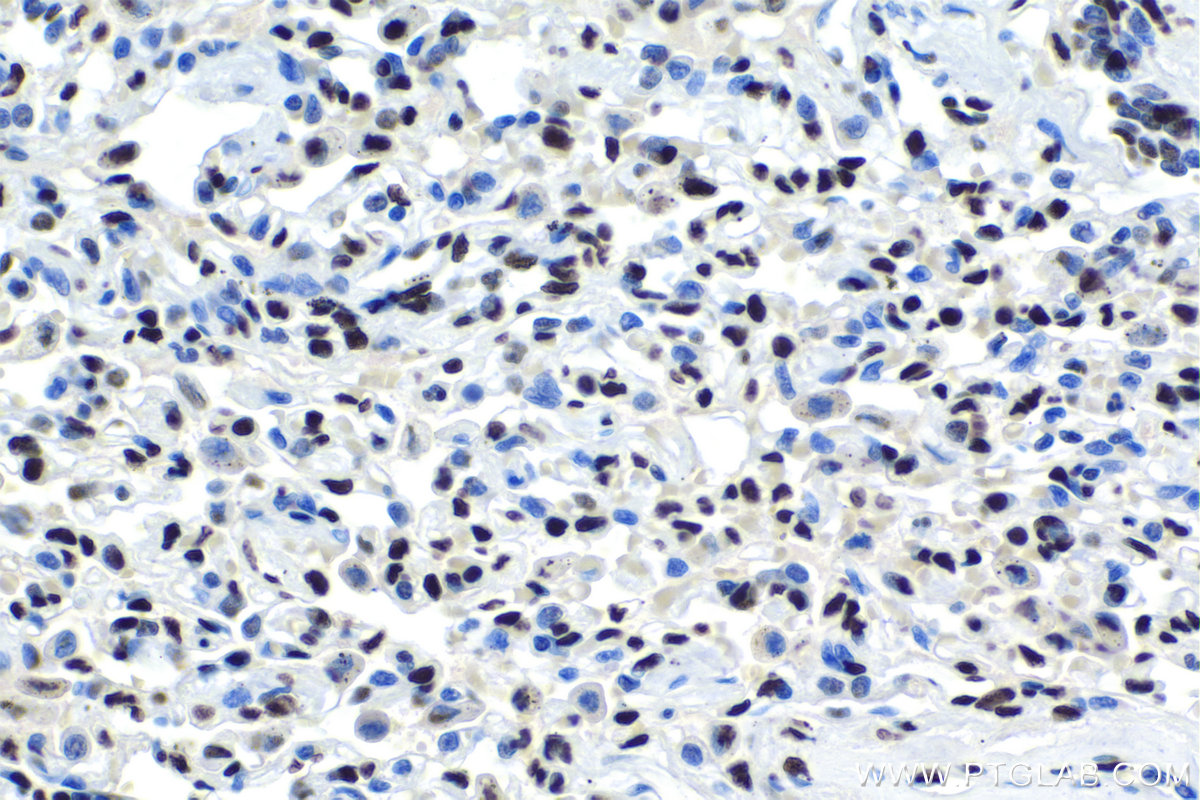 Immunohistochemical analysis of paraffin-embedded human lung cancer tissue slide using KHC1695 (ILF3 IHC Kit).