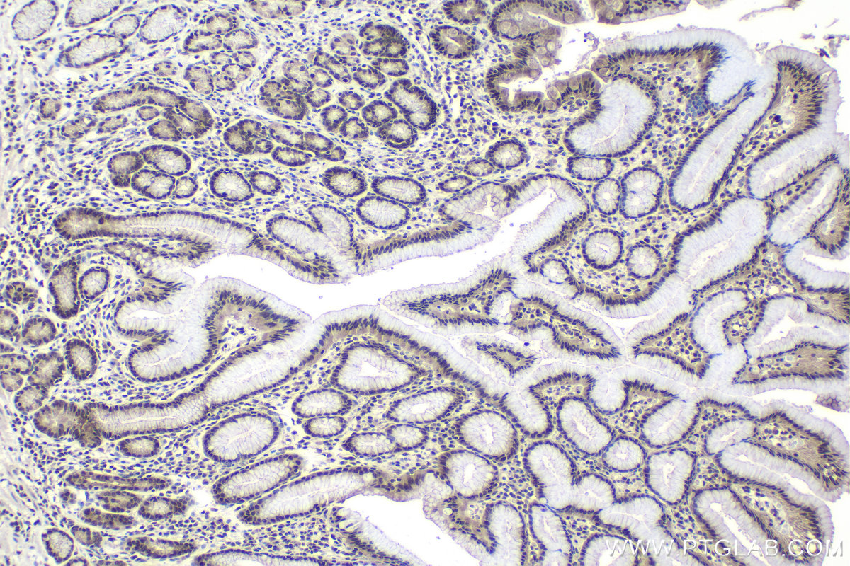 Immunohistochemical analysis of paraffin-embedded human stomach cancer tissue slide using KHC1022 (ILKAP IHC Kit).