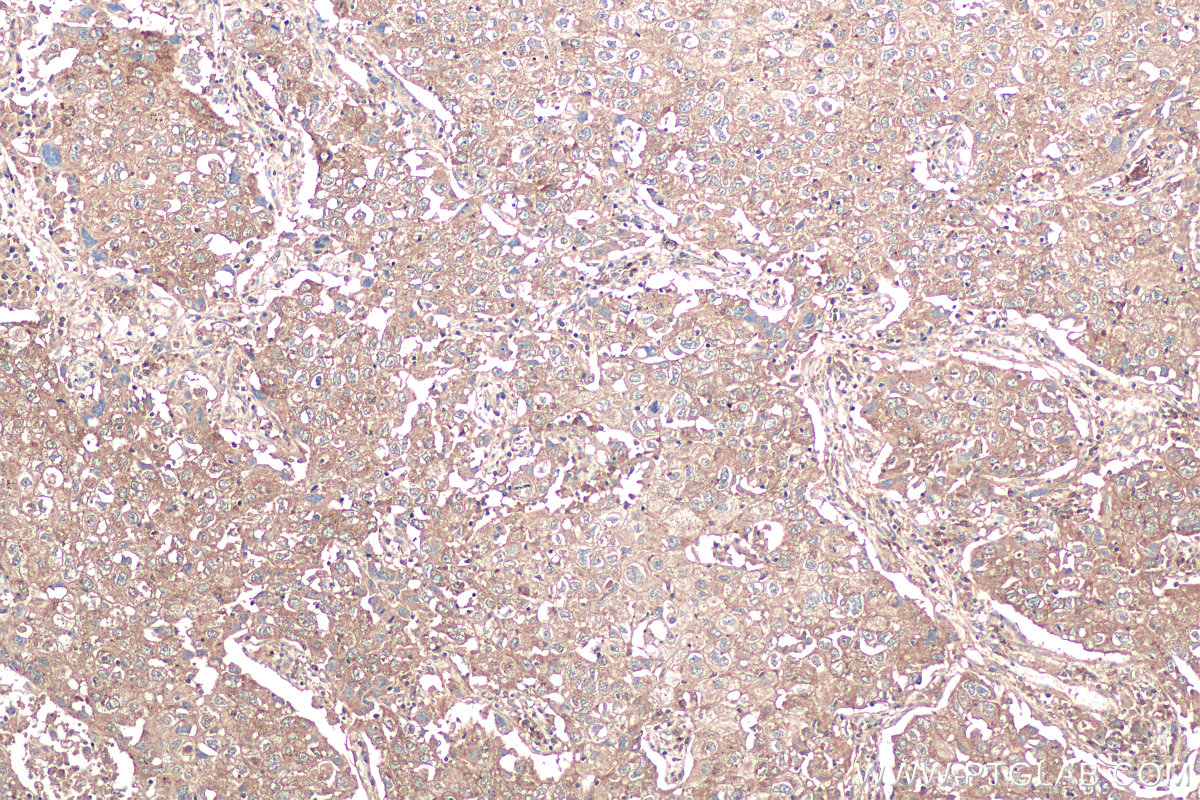 Immunohistochemical analysis of paraffin-embedded human lung cancer tissue slide using KHC0911 (IMPDH1 IHC Kit).