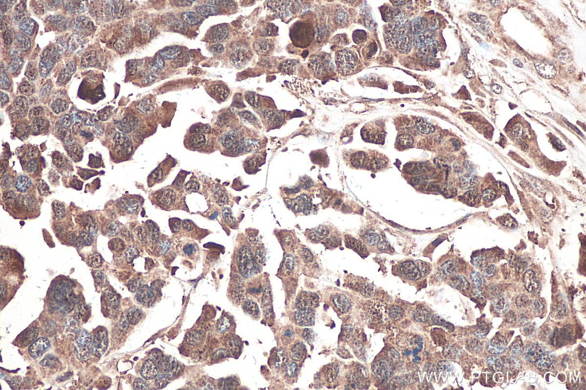 Immunohistochemical analysis of paraffin-embedded human colon cancer tissue slide using KHC0911 (IMPDH1 IHC Kit).
