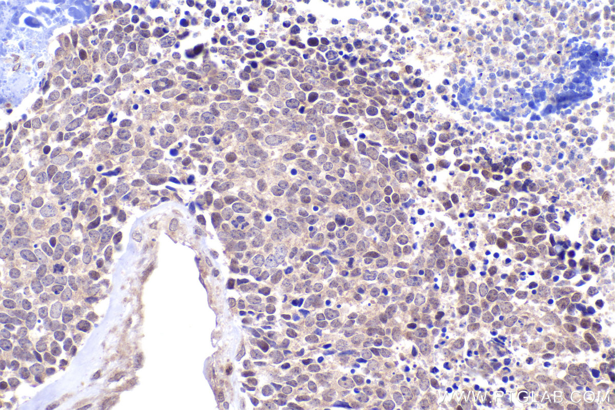 Immunohistochemical analysis of paraffin-embedded human lung cancer tissue slide using KHC2404 (INCA1 IHC Kit).