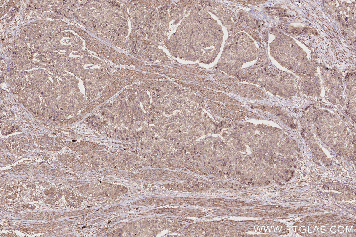 Immunohistochemical analysis of paraffin-embedded human stomach cancer tissue slide using KHC2813 (INPP4A IHC Kit).