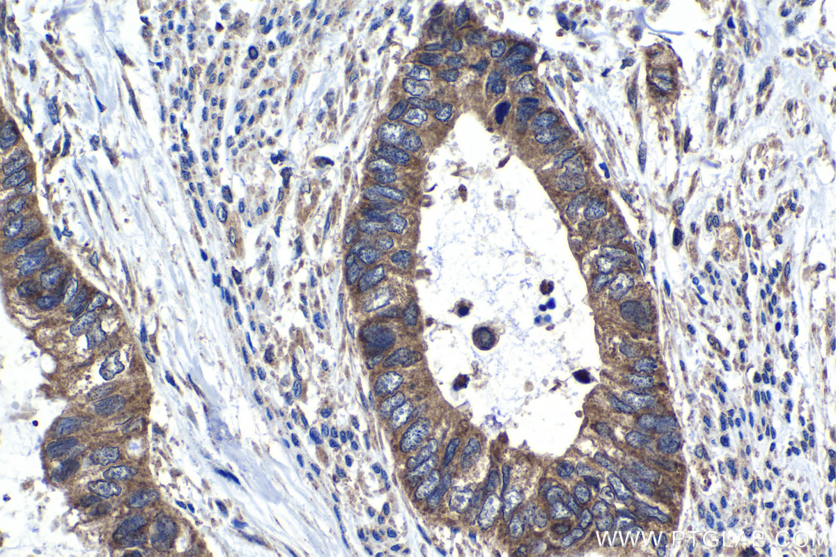 Immunohistochemical analysis of paraffin-embedded human urothelial carcinoma tissue slide using KHC1444 (INPPL1 IHC Kit).