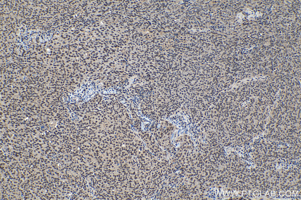 Immunohistochemical analysis of paraffin-embedded human ovary tumor tissue slide using KHC1248 (IPO7 IHC Kit).
