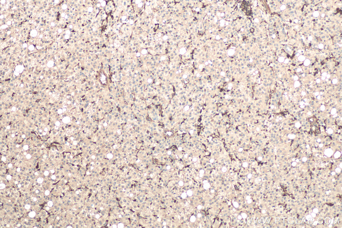 Immunohistochemical analysis of paraffin-embedded human liver cancer tissue slide using KHC0678 (IQGAP1 IHC Kit).