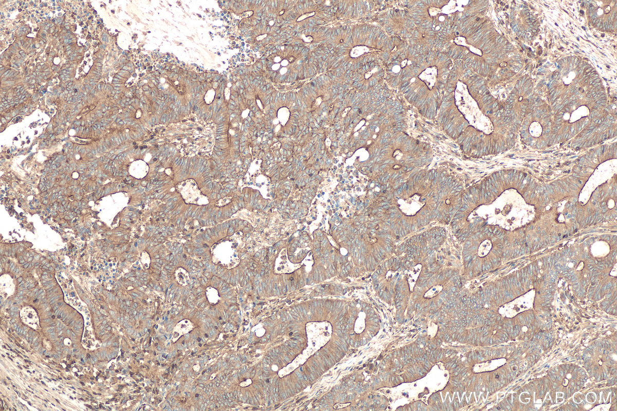 Immunohistochemical analysis of paraffin-embedded human colon cancer tissue slide using KHC0678 (IQGAP1 IHC Kit).