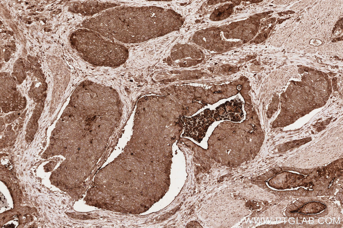 Immunohistochemical analysis of paraffin-embedded human stomach cancer tissue slide using KHC2636 (IQGAP3 IHC Kit).
