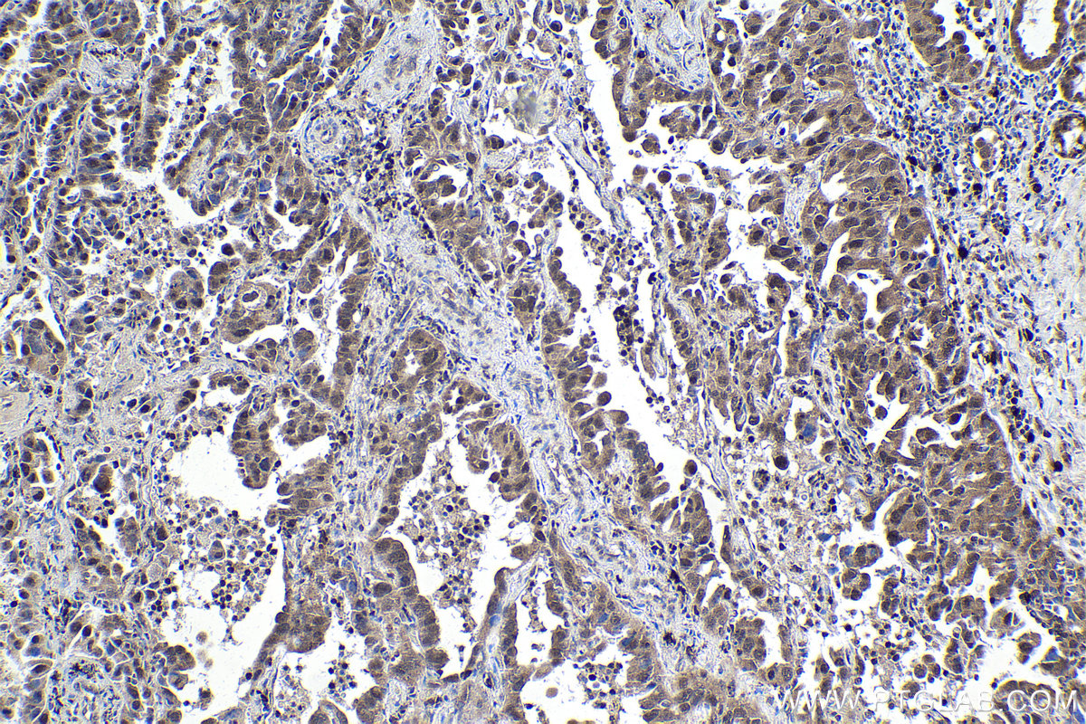 Immunohistochemical analysis of paraffin-embedded human lung cancer tissue slide using KHC1804 (IRF2BP2 IHC Kit).