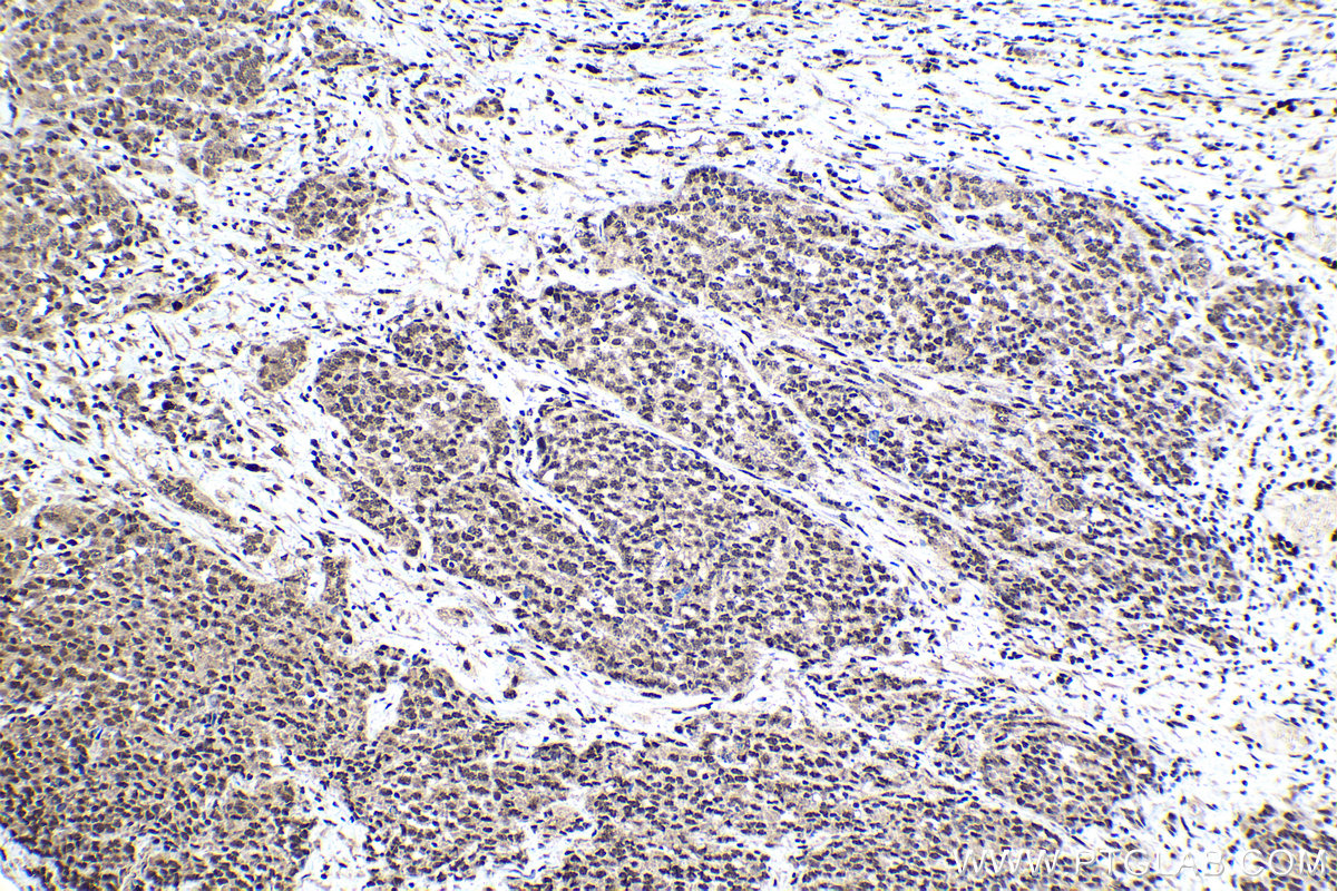 Immunohistochemical analysis of paraffin-embedded human ovary tumor tissue slide using KHC1137 (IRF3 IHC Kit).