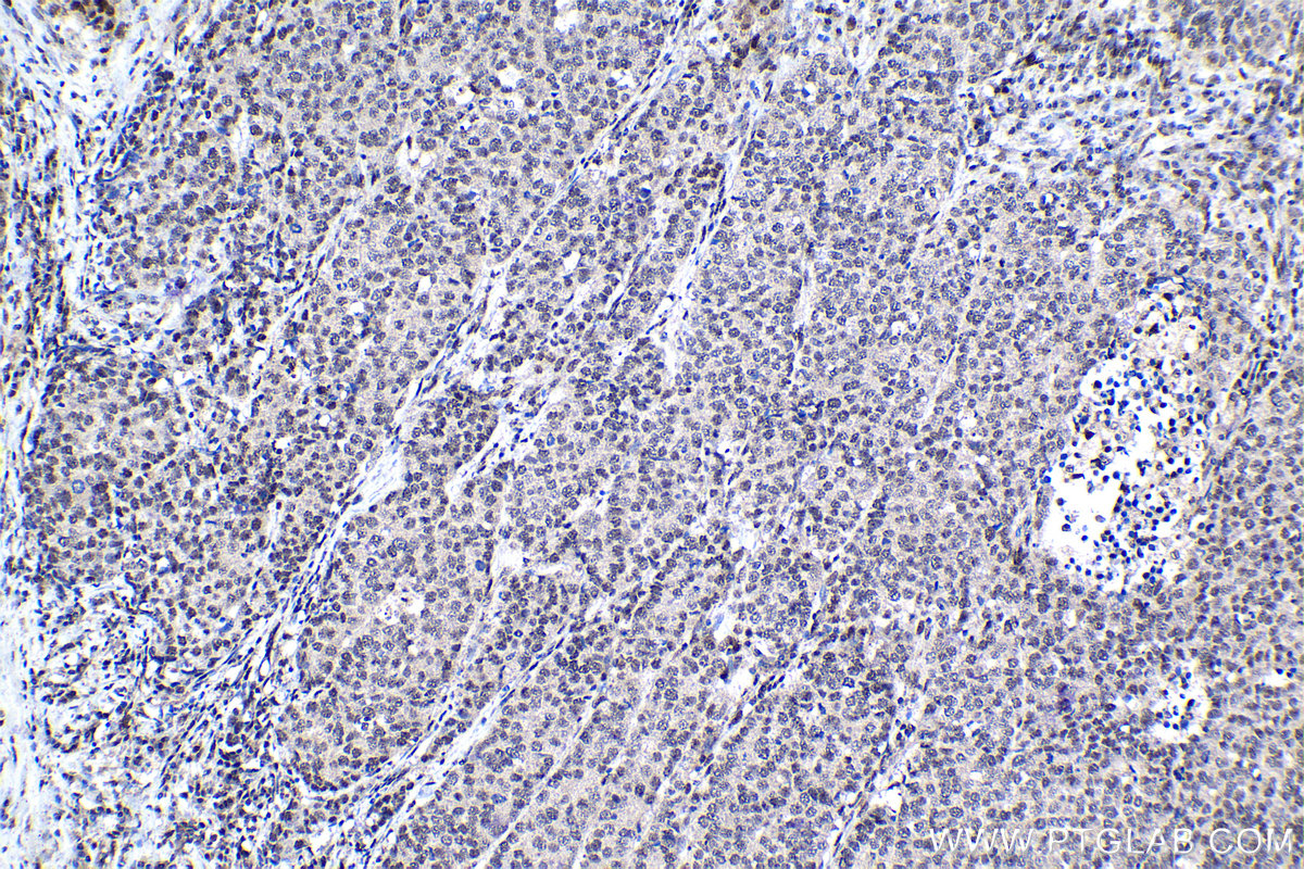 Immunohistochemical analysis of paraffin-embedded human stomach cancer tissue slide using KHC1137 (IRF3 IHC Kit).