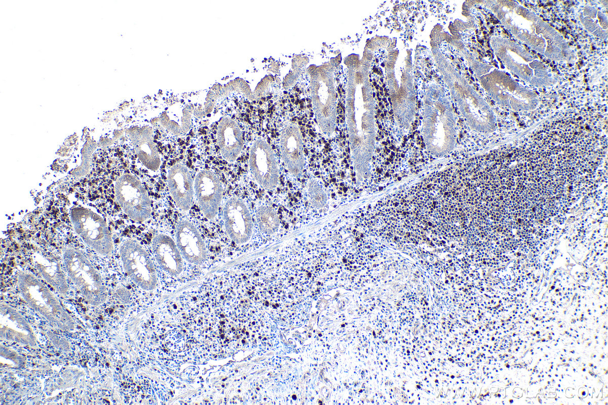 Immunohistochemical analysis of paraffin-embedded human appendicitis tissue slide using KHC1749 (IRF4 IHC Kit).