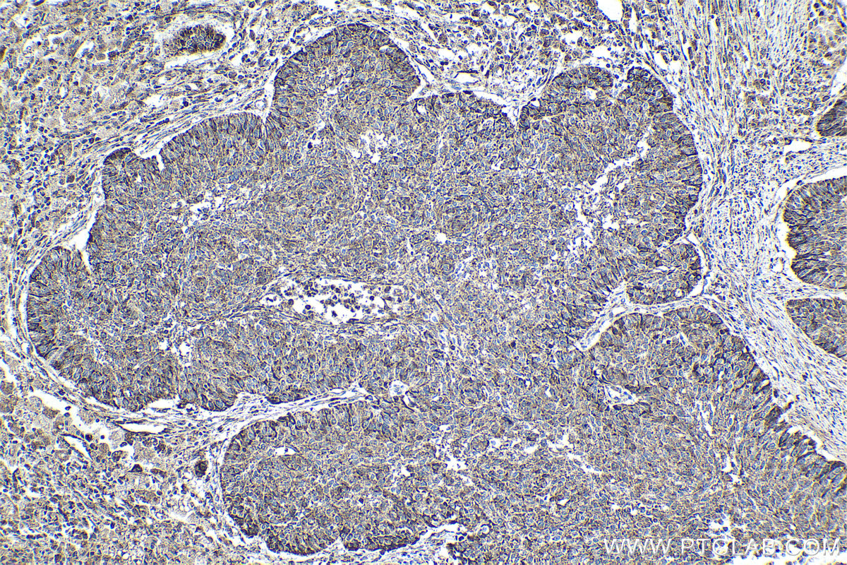 Immunohistochemical analysis of paraffin-embedded human lung cancer tissue slide using KHC1861 (IRF7 IHC Kit).