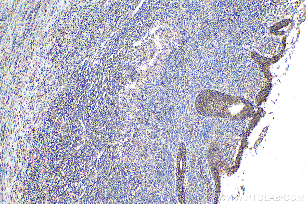 Immunohistochemical analysis of paraffin-embedded human appendicitis tissue slide using KHC1861 (IRF7 IHC Kit).