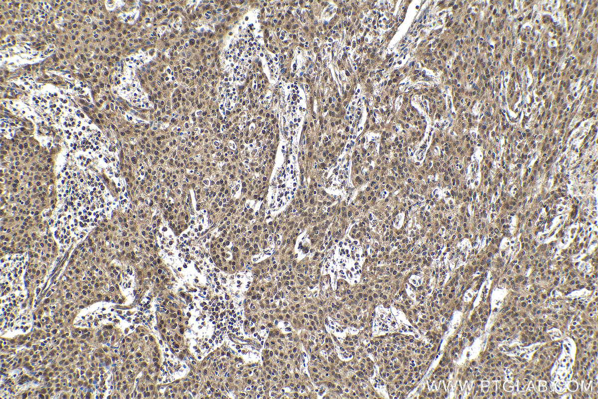 Immunohistochemical analysis of paraffin-embedded human cervical cancer tissue slide using KHC1660 (IRF9 IHC Kit).
