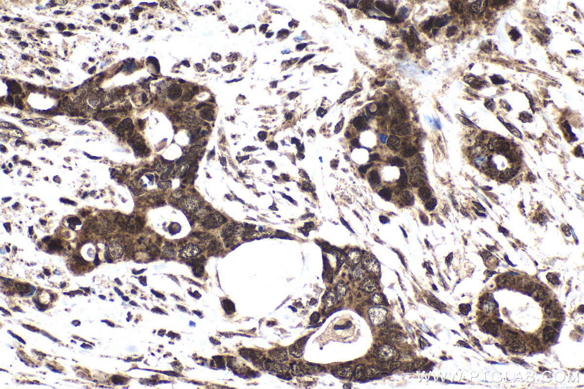 Immunohistochemical analysis of paraffin-embedded human urothelial carcinoma tissue slide using KHC1660 (IRF9 IHC Kit).